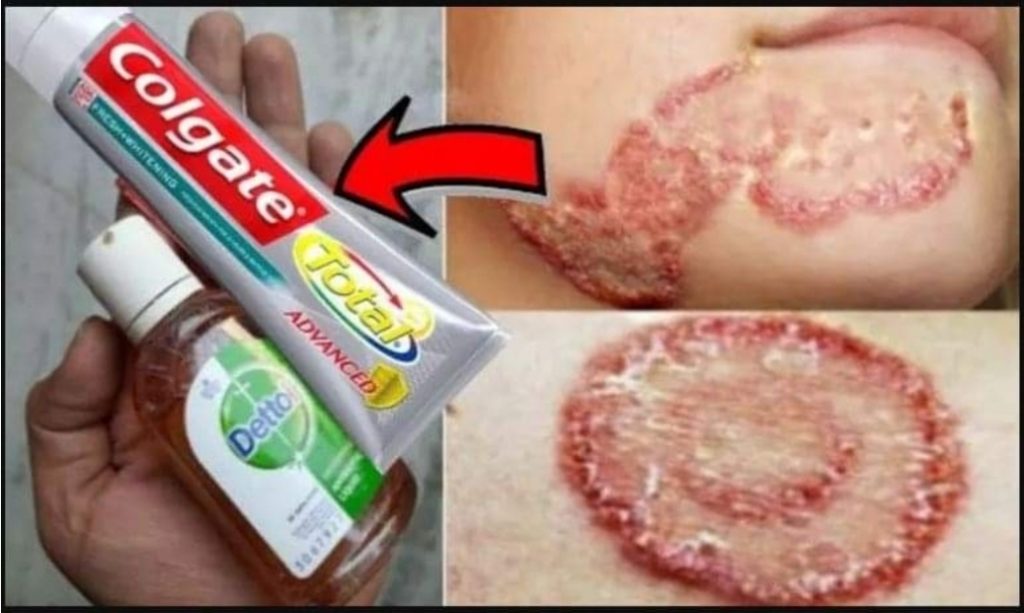 दाद, एलर्जी र अन्य कुनै छालाको समस्याबाट मुक्ति पाउन यसरी गर्नुहोस्