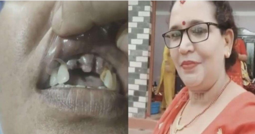 वीर अस्पतालको लापरबाही : पित्तथैली रहेको पत्थरीको अप्रेशन गर्ने बिरामीको तीन वटा दाँत निकालियो !